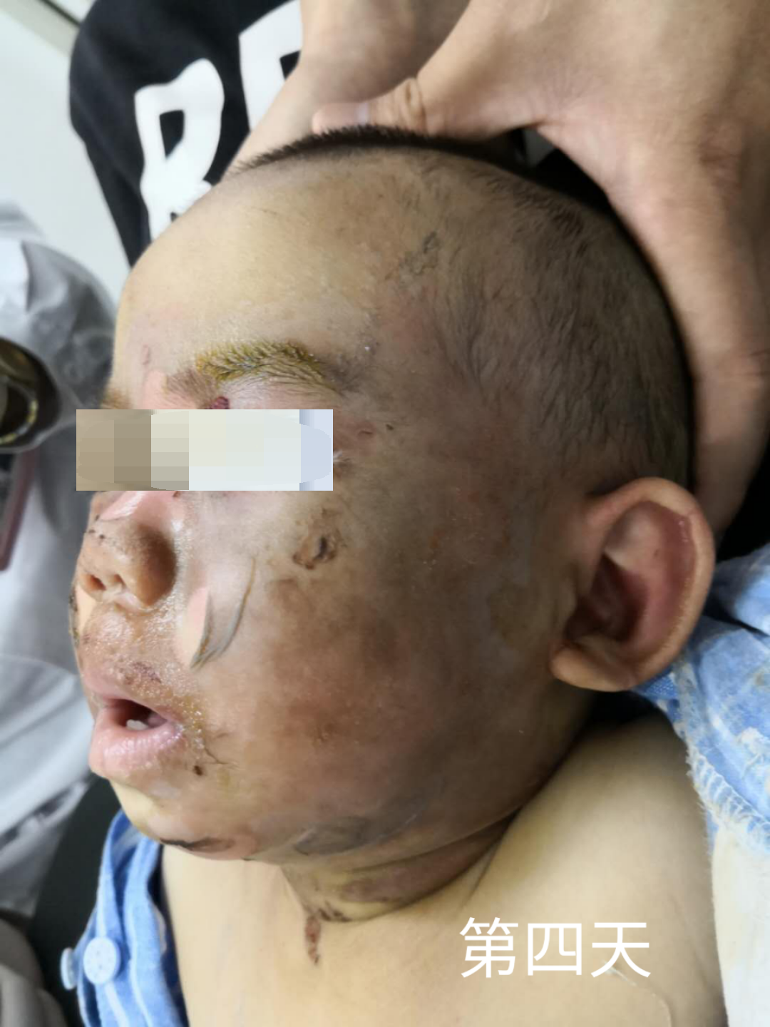 小儿面部烧烫伤家庭急救_烧伤_烧伤日常注意事项 - 好大夫在线