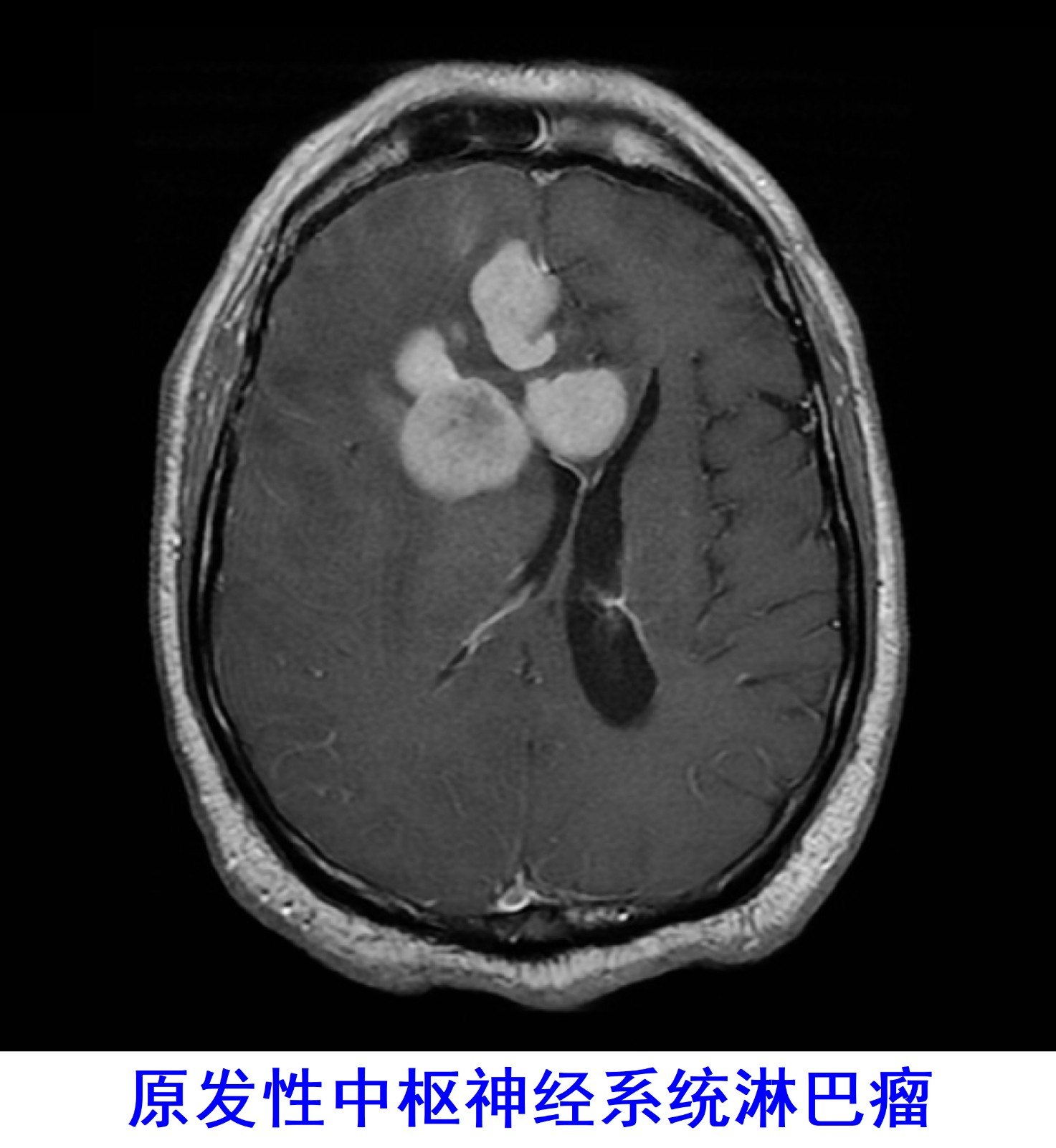 脑淋巴瘤图片