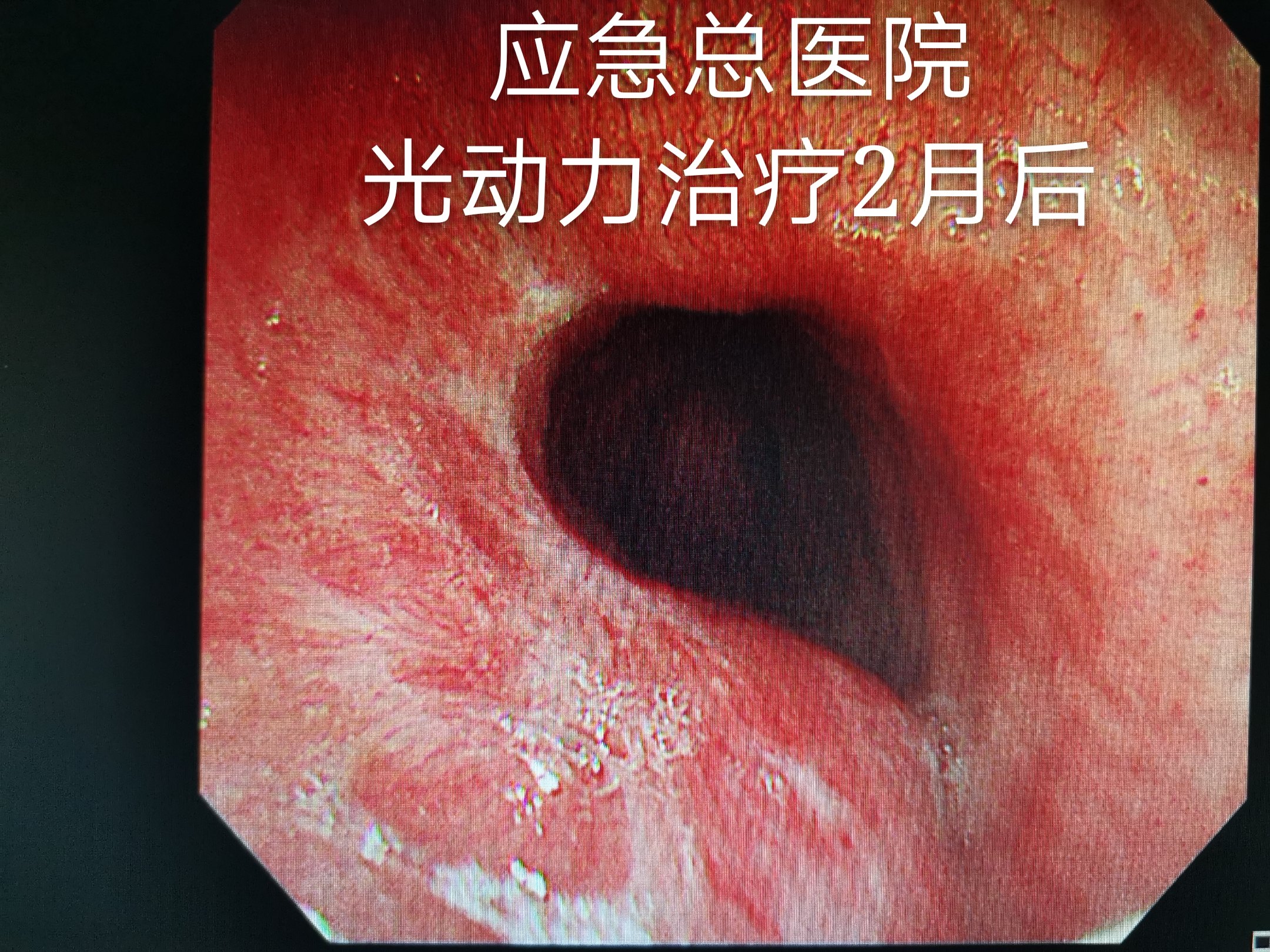 光动力疗法治疗气管腺样囊性癌_气管肿瘤_气管肿瘤治疗方式 - 好大夫