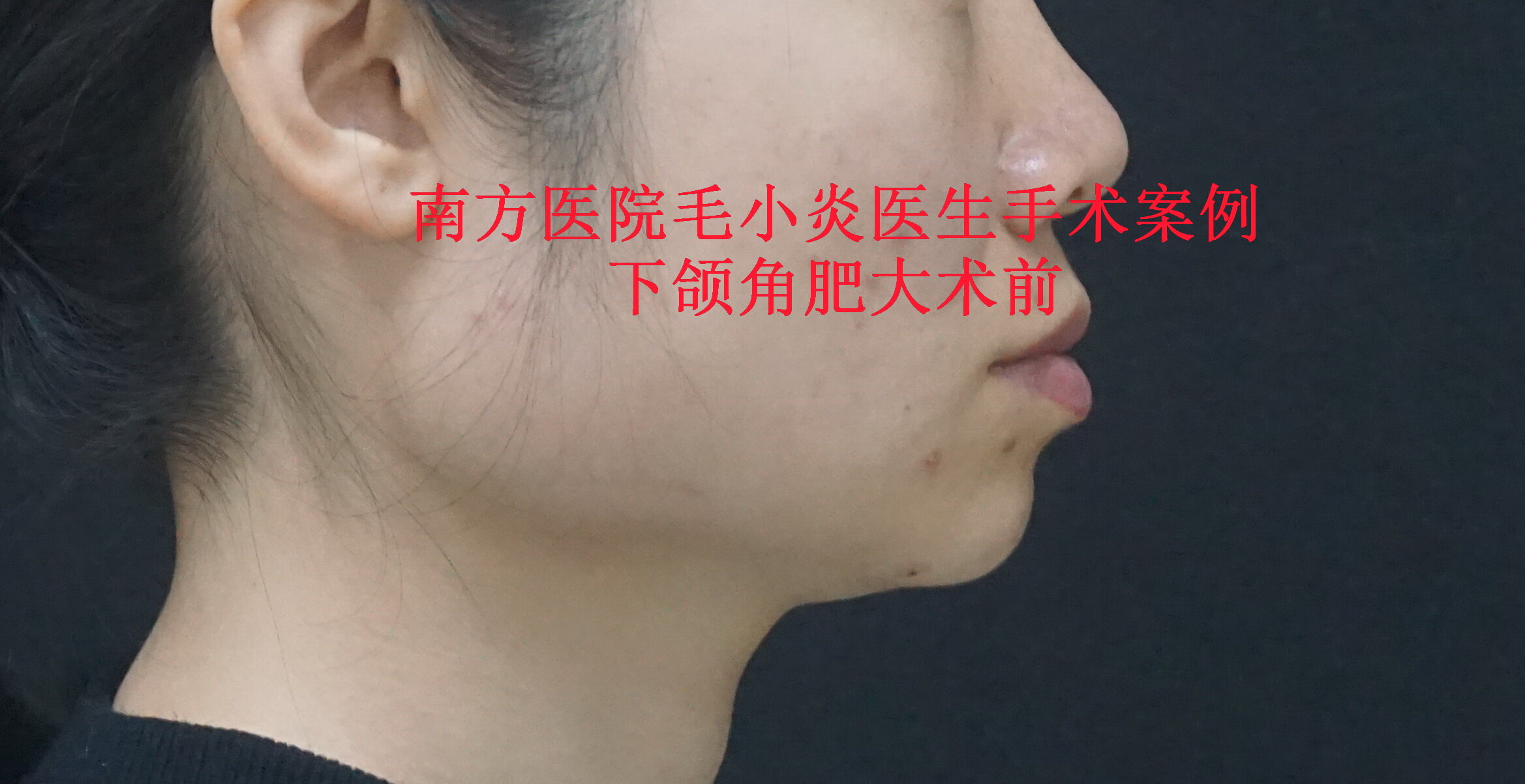 毛小炎医生下颌角肥大手术案例_下颌整形_下颌整形治疗介绍 - 好大夫