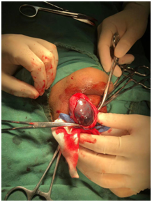 睾丸扭转手术图片图片