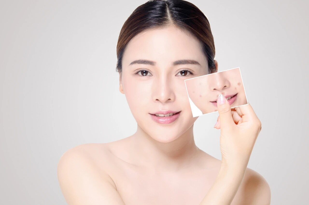 如何正确刷酸?_痤疮_治疗方式_治疗介绍 - 好大夫在线