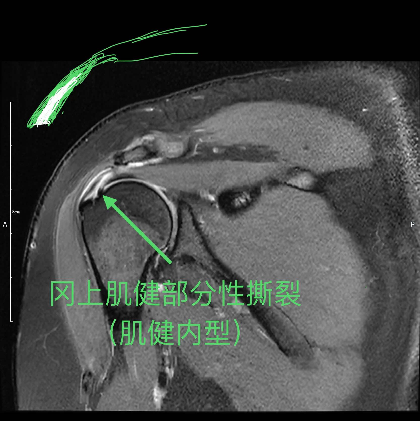 运动医学学习小贴士:冈上肌腱损伤MRI分型_肩关节损伤_相关疾病_介绍 - 好大夫在线