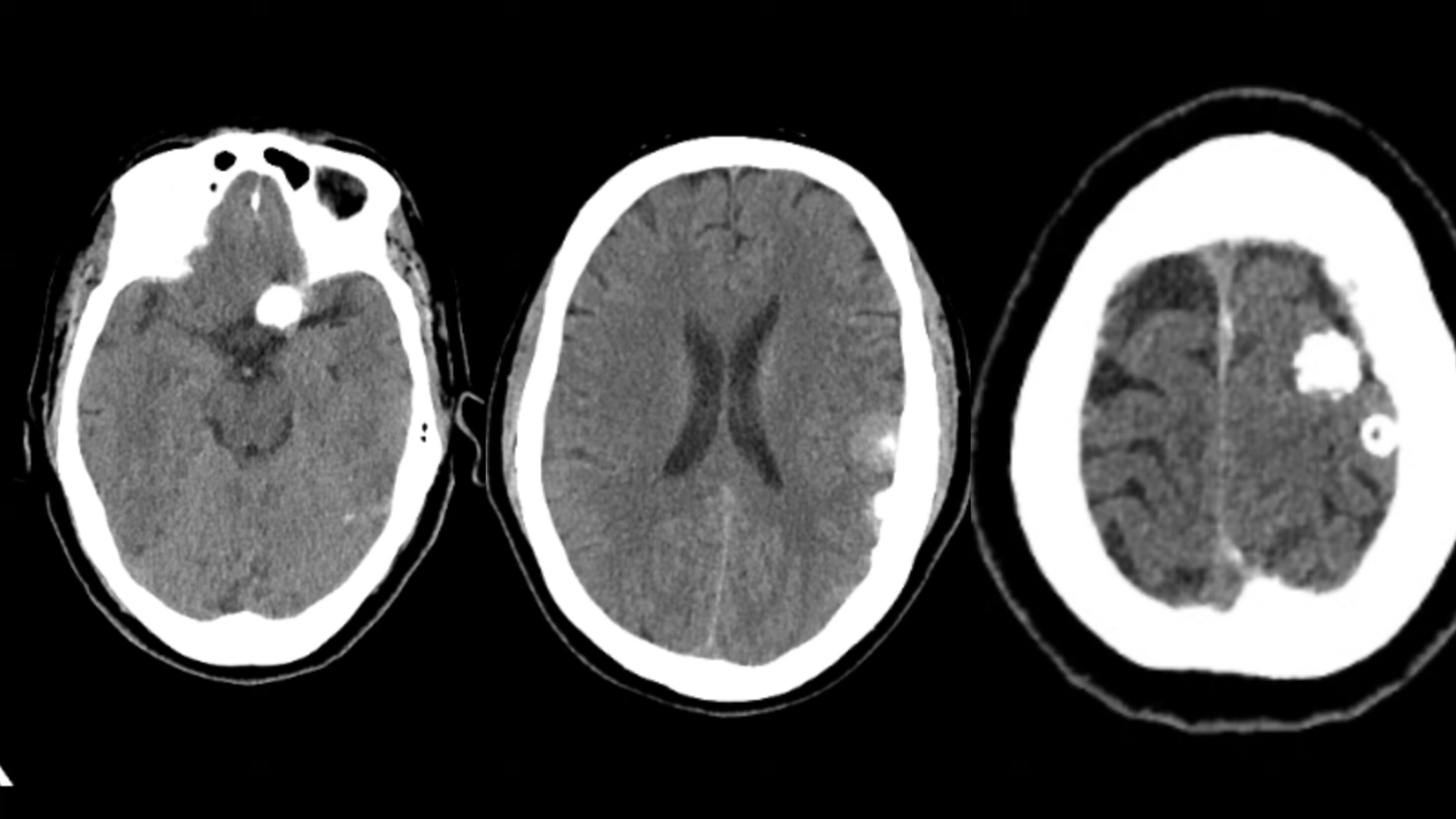 一次手术切除多发钙化性脑膜