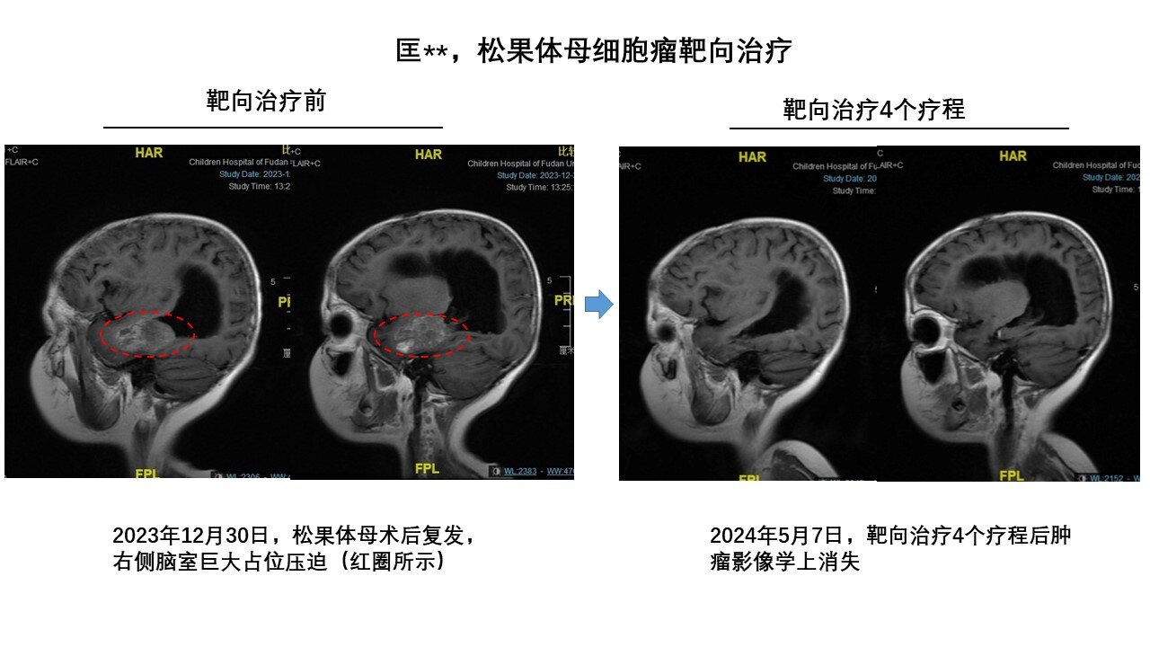 靶向治疗4个疗程矢状位.jpg