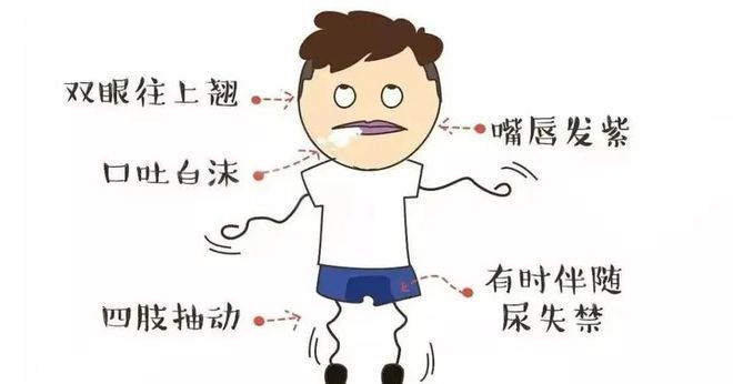癫痫图1.jpeg