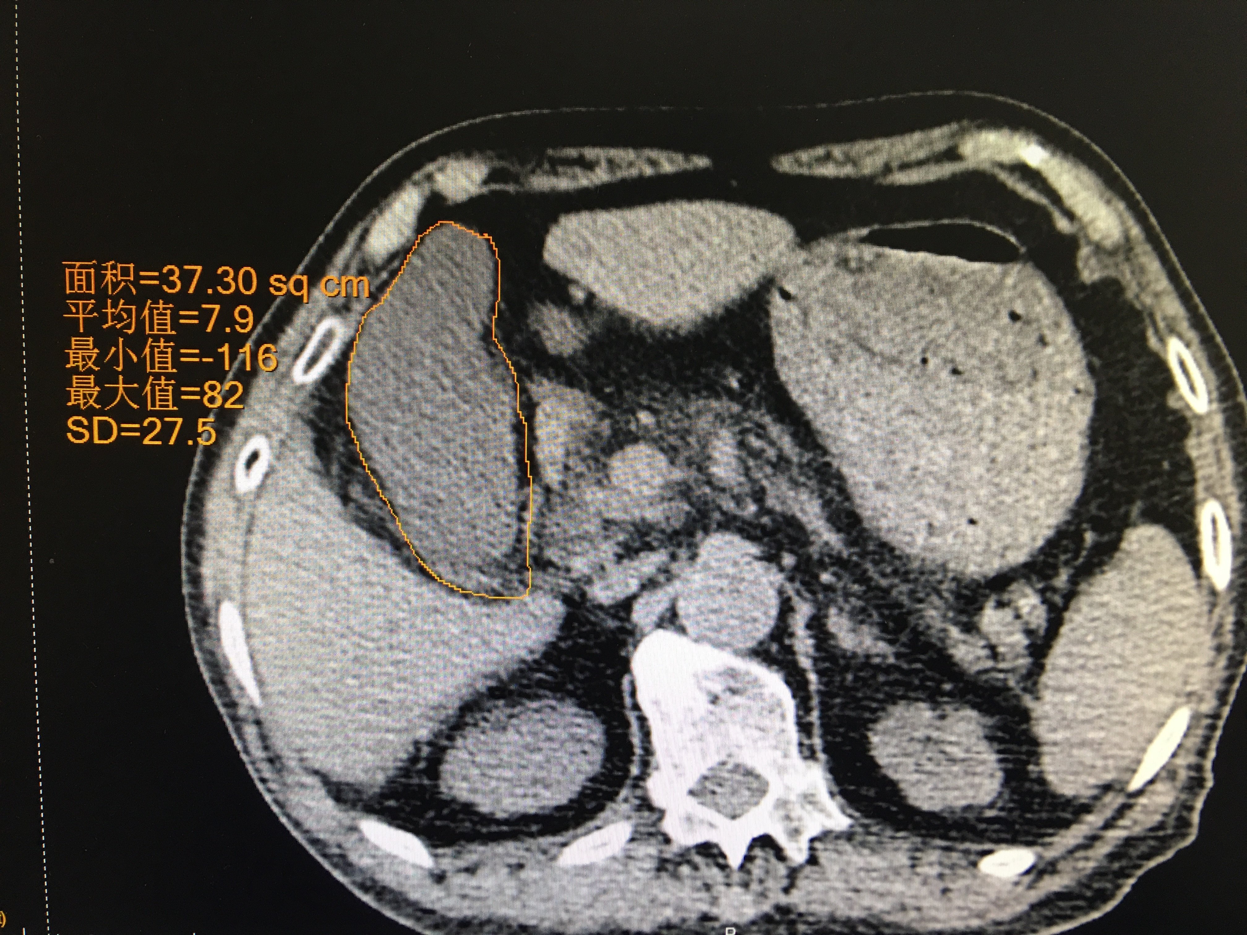 膽管結石容易誘發急性膽源性胰腺炎