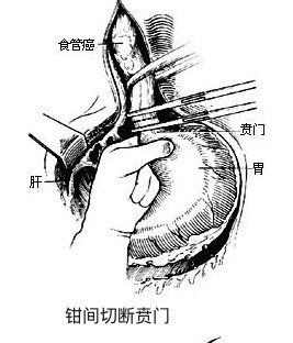 同時頸部切斷食管,切除食管病變段最後將管狀胃與食管頸部斷端吻合