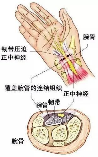 手腕当中有个通道叫作腕管,由屈肌支持带(腕横韧带)与腕骨沟共同构成