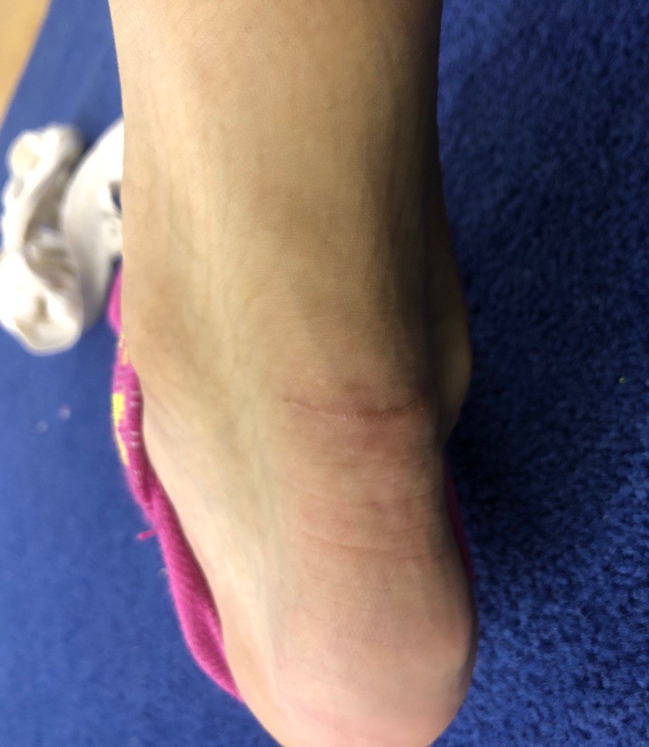 跟腱断裂 可以更加微创 好大夫在线 跟腱断裂 可以更加微创 好大夫在线