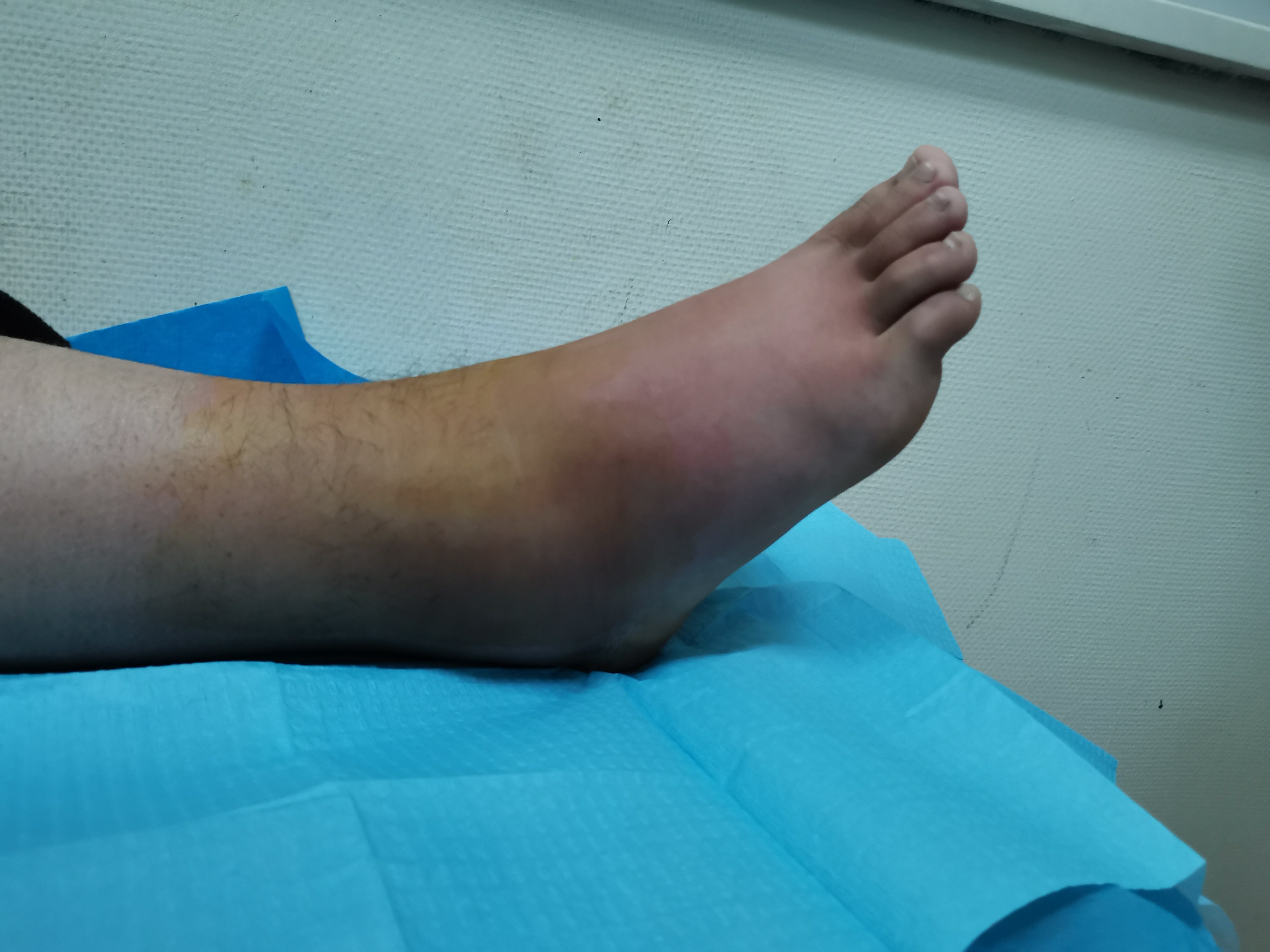 患儿患肢疼痛,不愿活动,警惕急性血源性骨髓炎