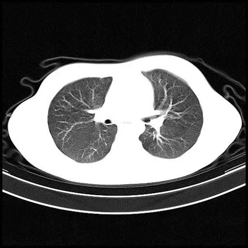 先来看一下正常人的胸部ct:胸廓的横径和前后径的比例是3:2,双肺纹理