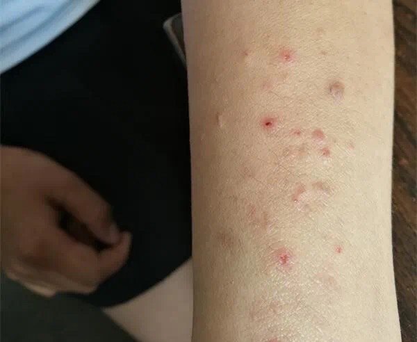 光过敏、多形性日光疹_日光性皮炎_日光性皮炎介绍 - 好大夫在线