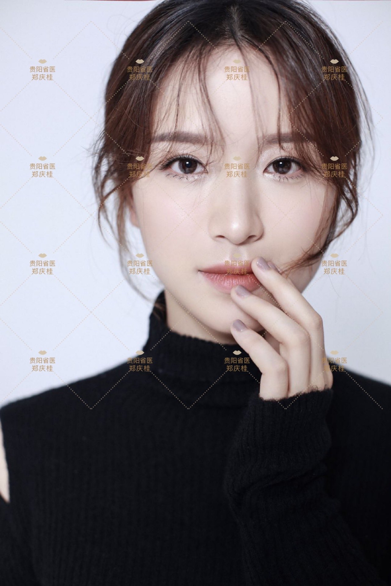 自然款双眼皮手术后2年多对比照片