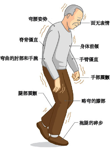 障碍,甚至痴呆;睡眠障碍,包括多梦,早起或白天入睡;自主神经功能障碍