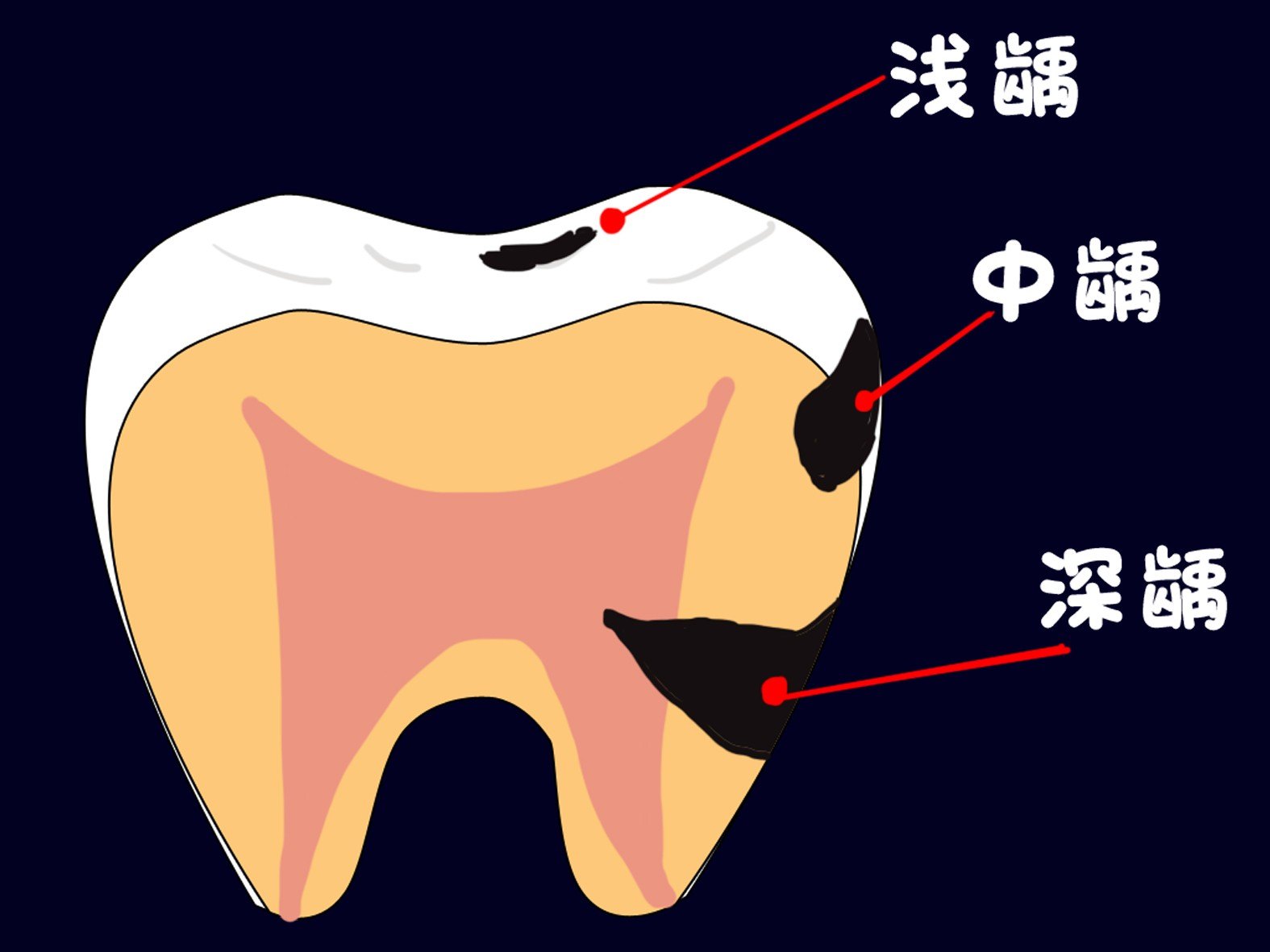 牙齒上面的黑線是什麼?