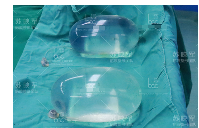 图为手术取出的扩张器手术过程中,我先将曹女士双肩的扩张器完整取出