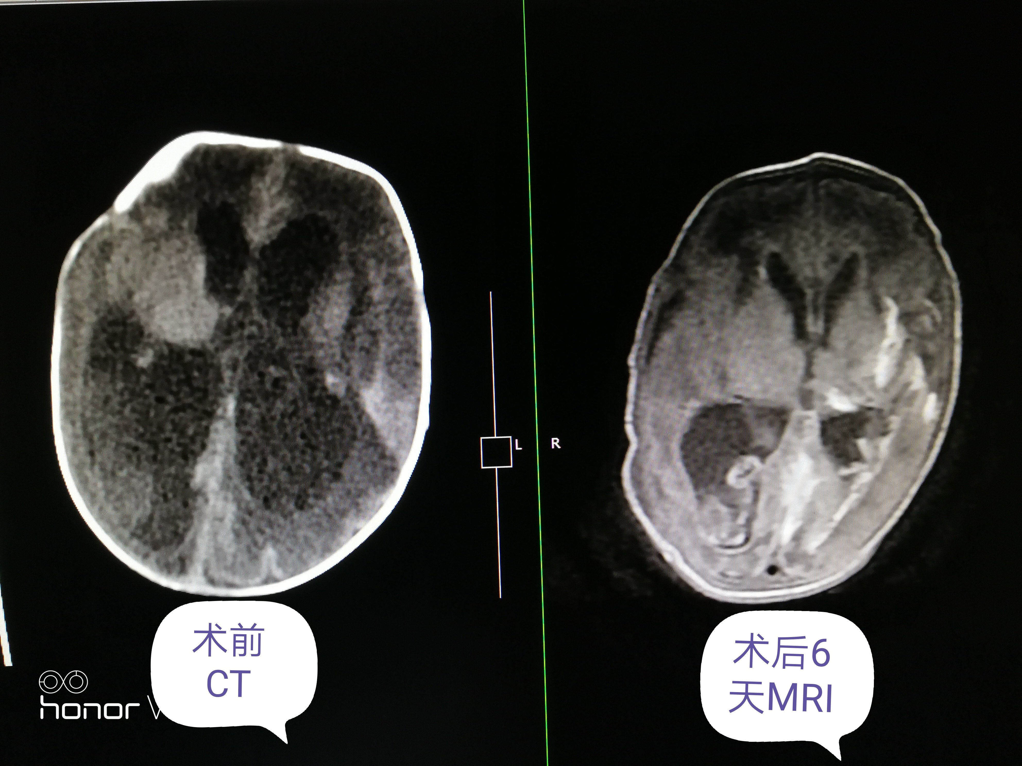 脑室帽状腱膜下分流术治疗早产儿脑积水