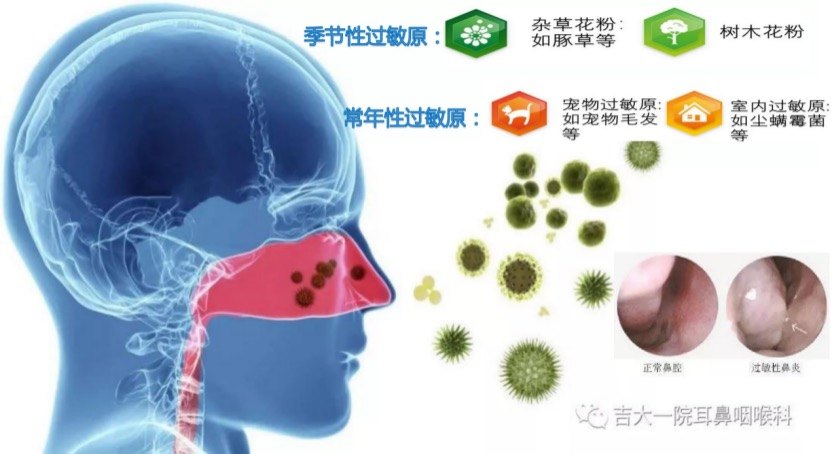 3分钟告诉你过敏性鼻炎的硬核知识_过敏性鼻炎_检查_治疗方式 - 好