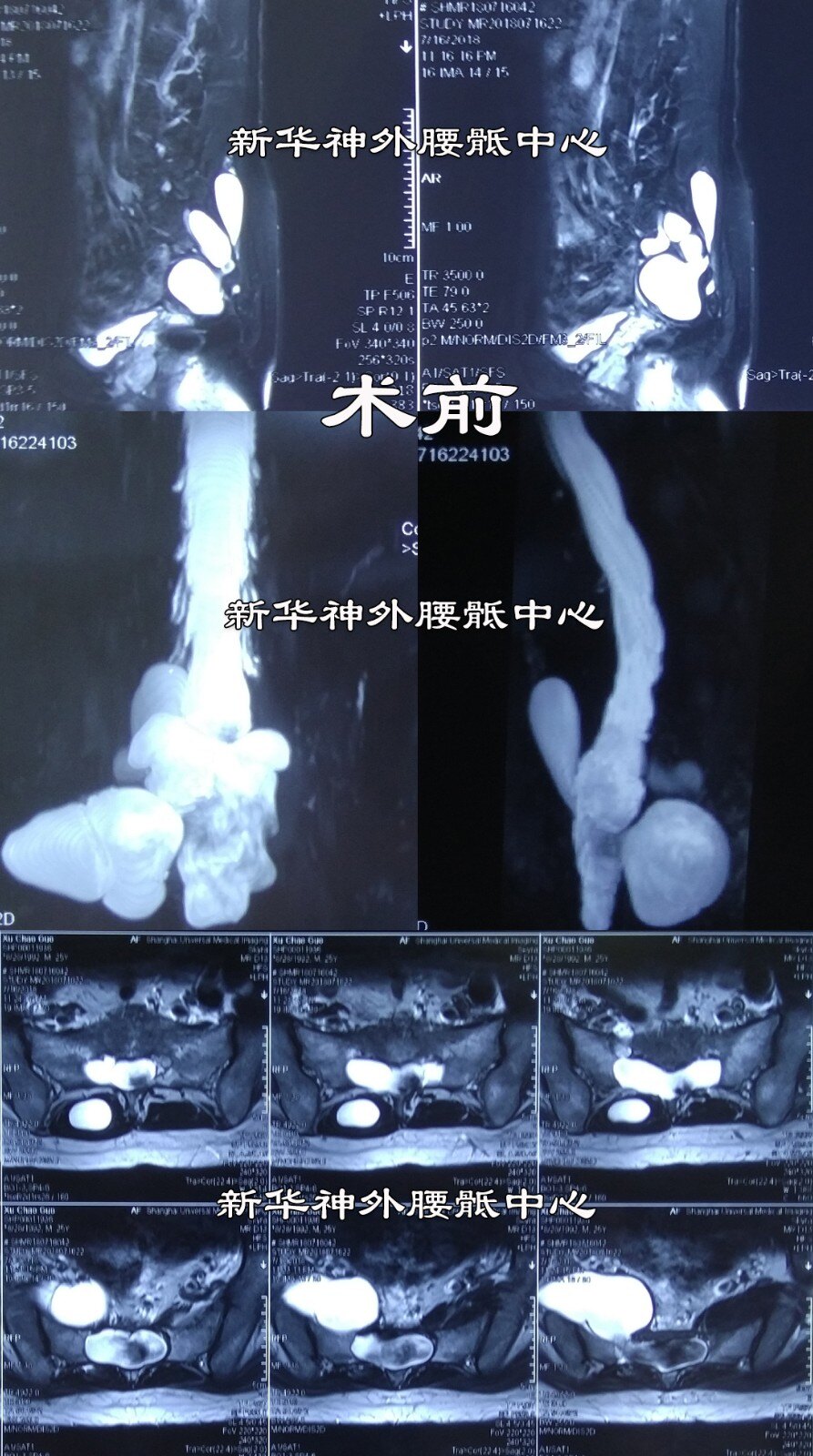 巨大骶管囊腫突入盆腔並穿破骶管後壁封堵術後3個月上班