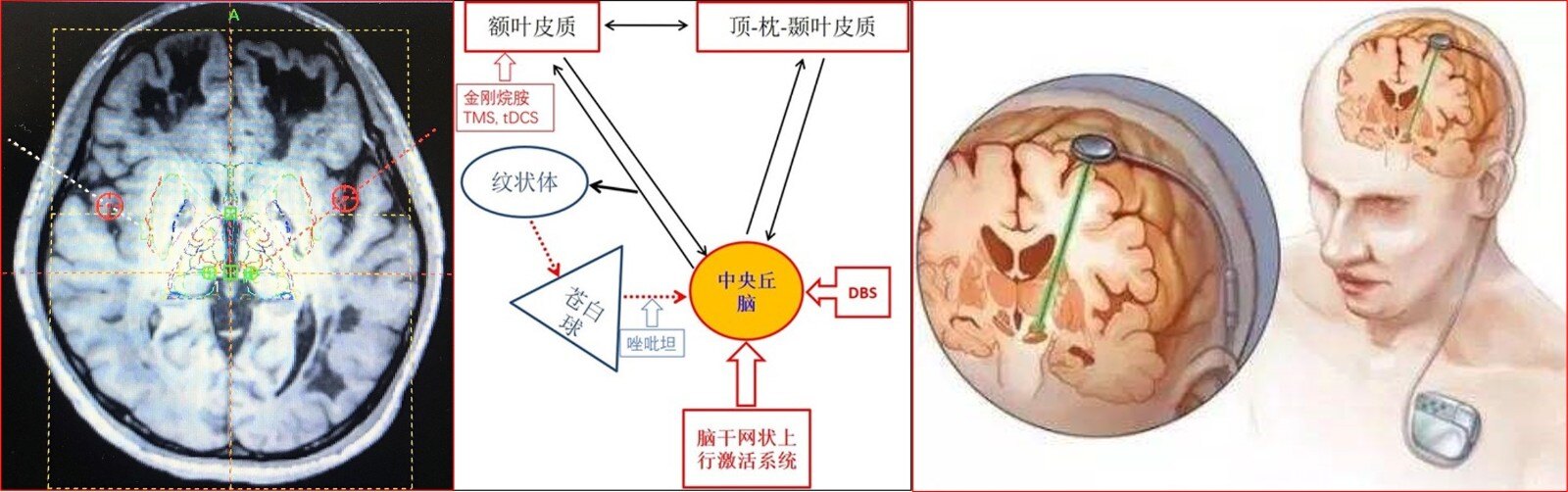 DBS组合.jpg