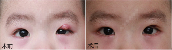 霰粒肿手术前后照片 强脉冲新疗法非手术治疗霰粒肿 霰粒肿 饮食运动 症状 治疗方法