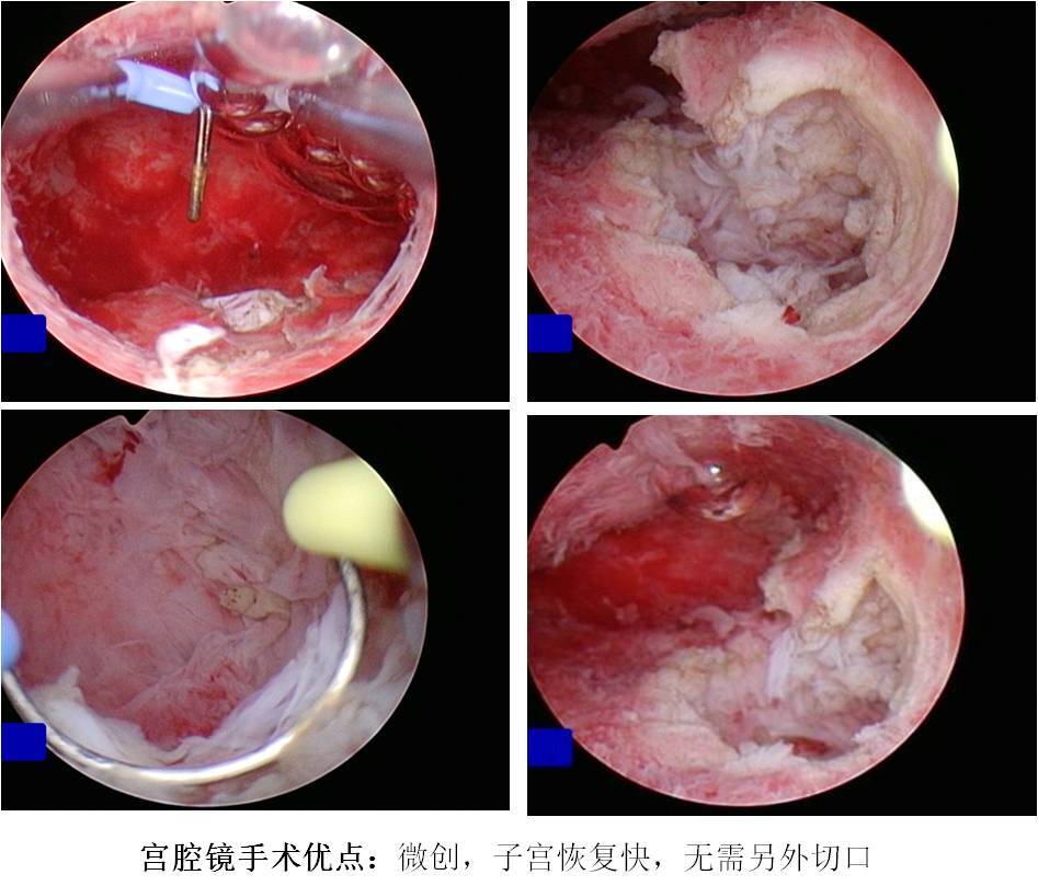 宫腔镜手术系列之三