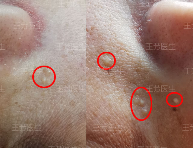 粟丘疹案例分享_粟丘疹_介绍_症状表现 - 好大夫在线