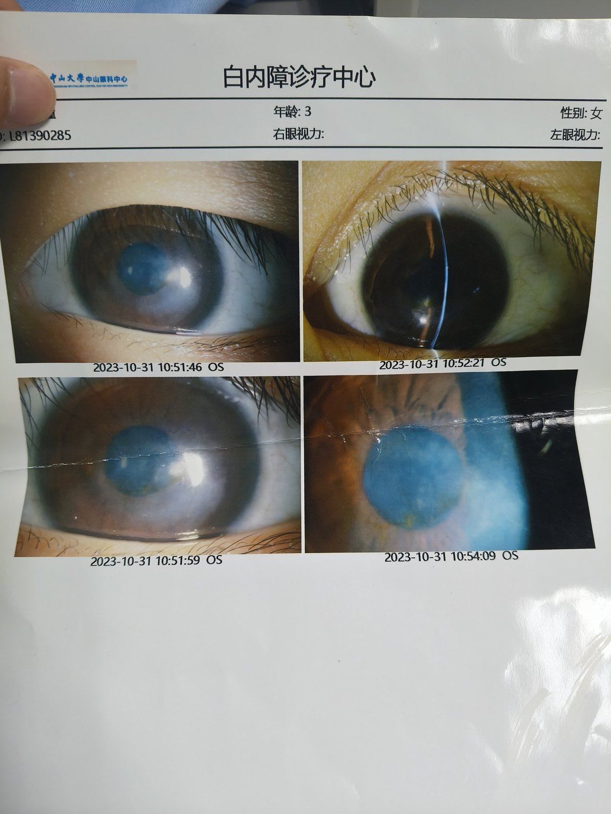 一例3岁儿童陈旧性病毒性角膜炎角膜斑翳患儿