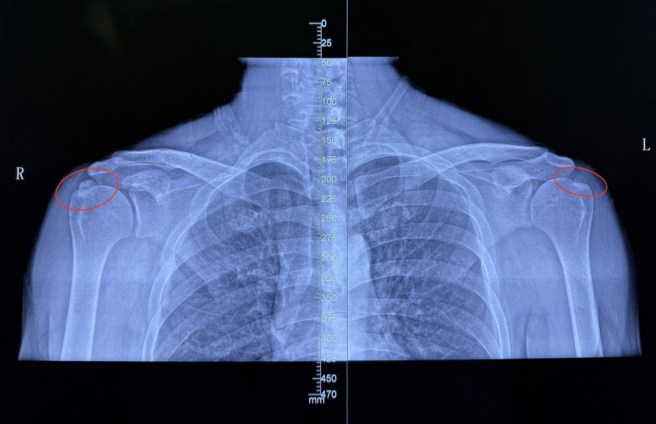 肩关节钙化性肌腱炎