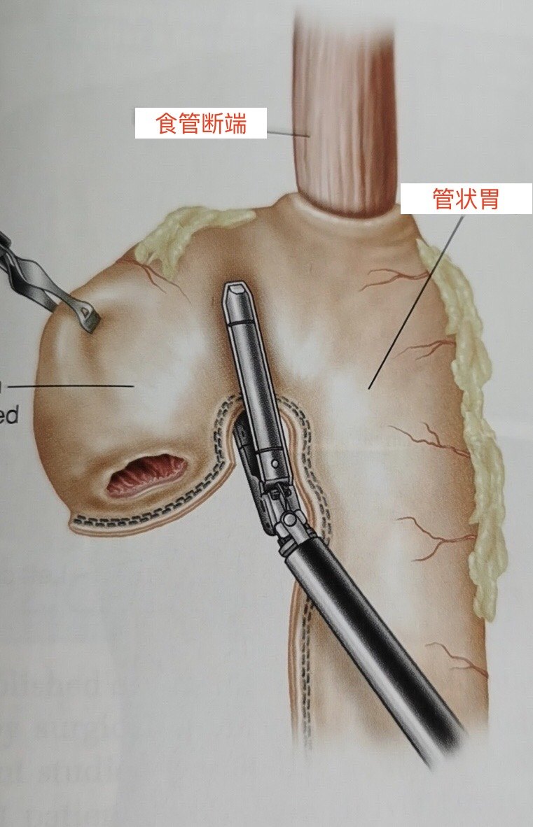 肠子吻合器图解图片
