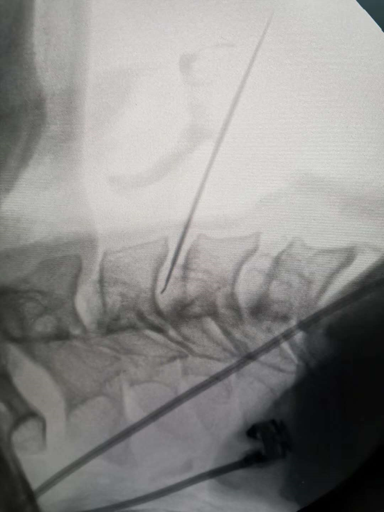 腰椎间盘突出的介入治疗是什么原理(2)