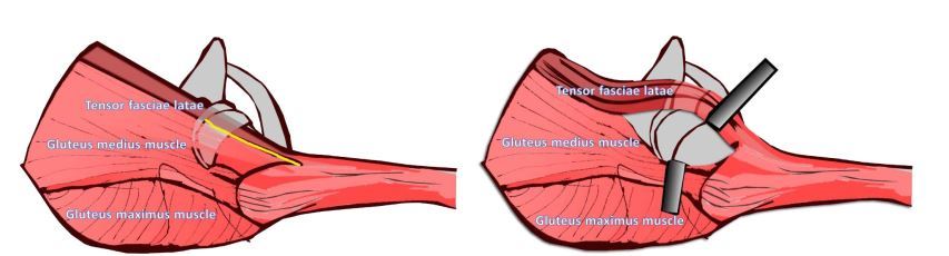 1587915249704188.jpg 从臀中肌前缘和阔筋膜张肌后缘之间进入髋关节。臀中肌向后拉,阔筋膜张肌向前拉。.jpg