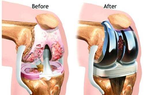 Total-Knee-Replacement.jpg