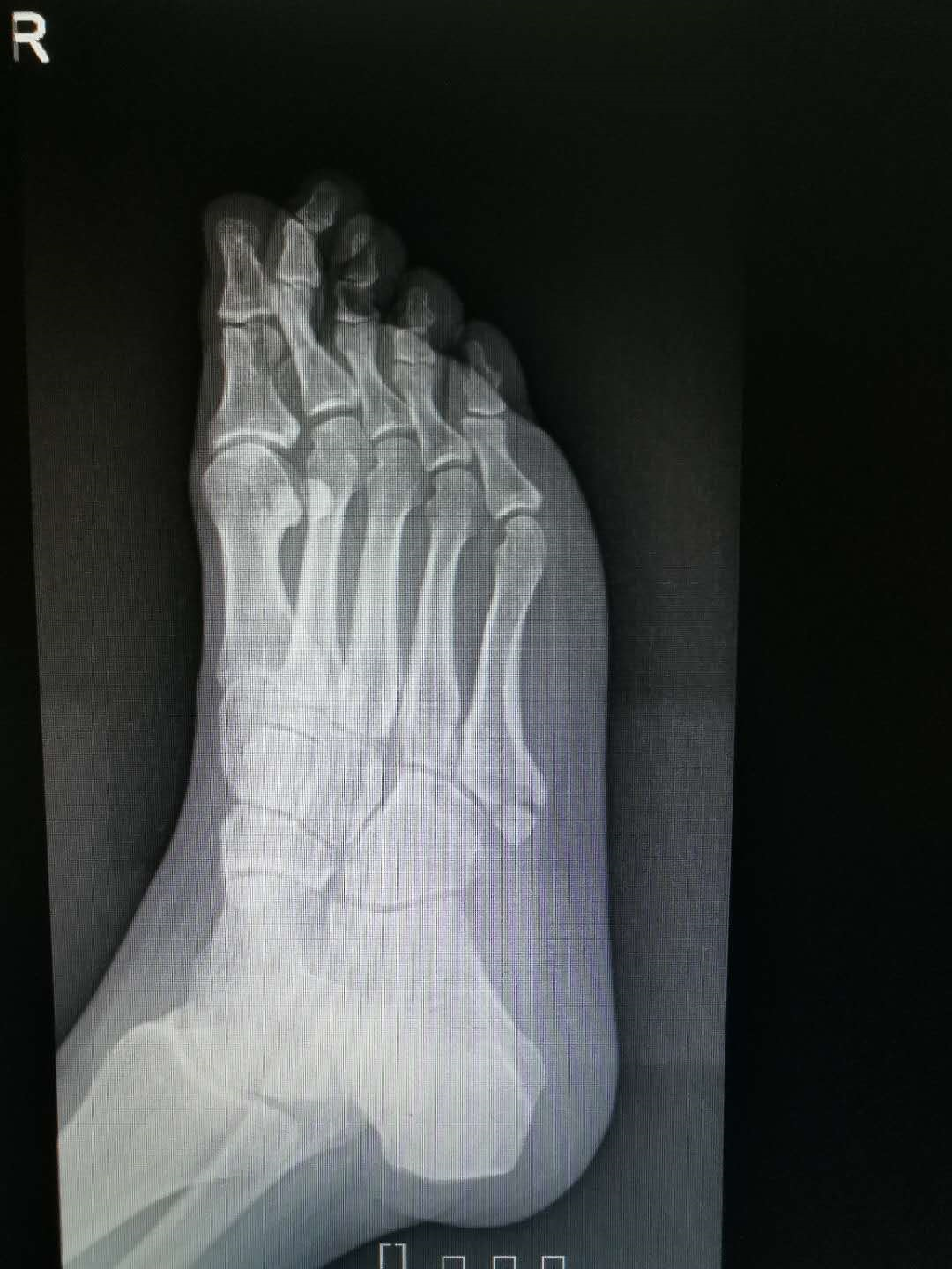 第五跖骨基底部骨折是否需要手术治疗 跖骨骨折 第五跖骨基底部骨折是否需要手术治疗 跖骨骨折