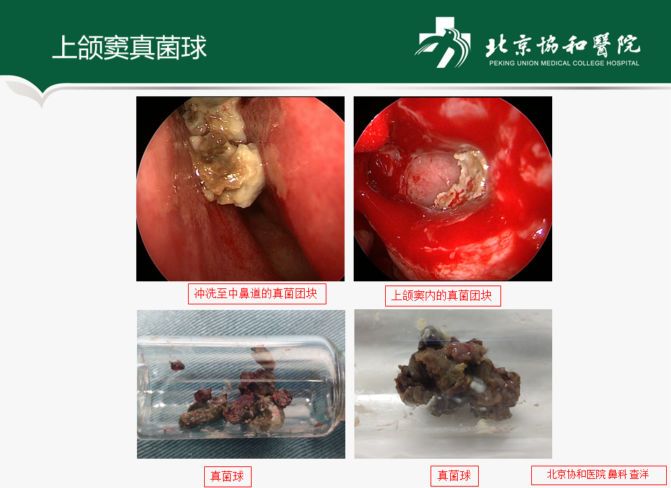 上颌窦炎怎么治疗最好图片