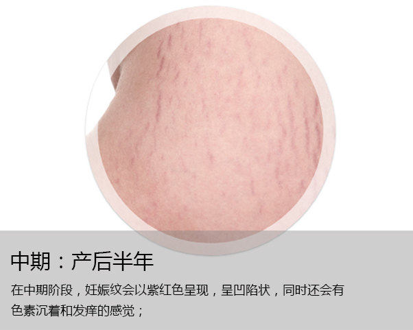关于妊娠纹预防与治疗——妊娠纹究竟应该如何去除?