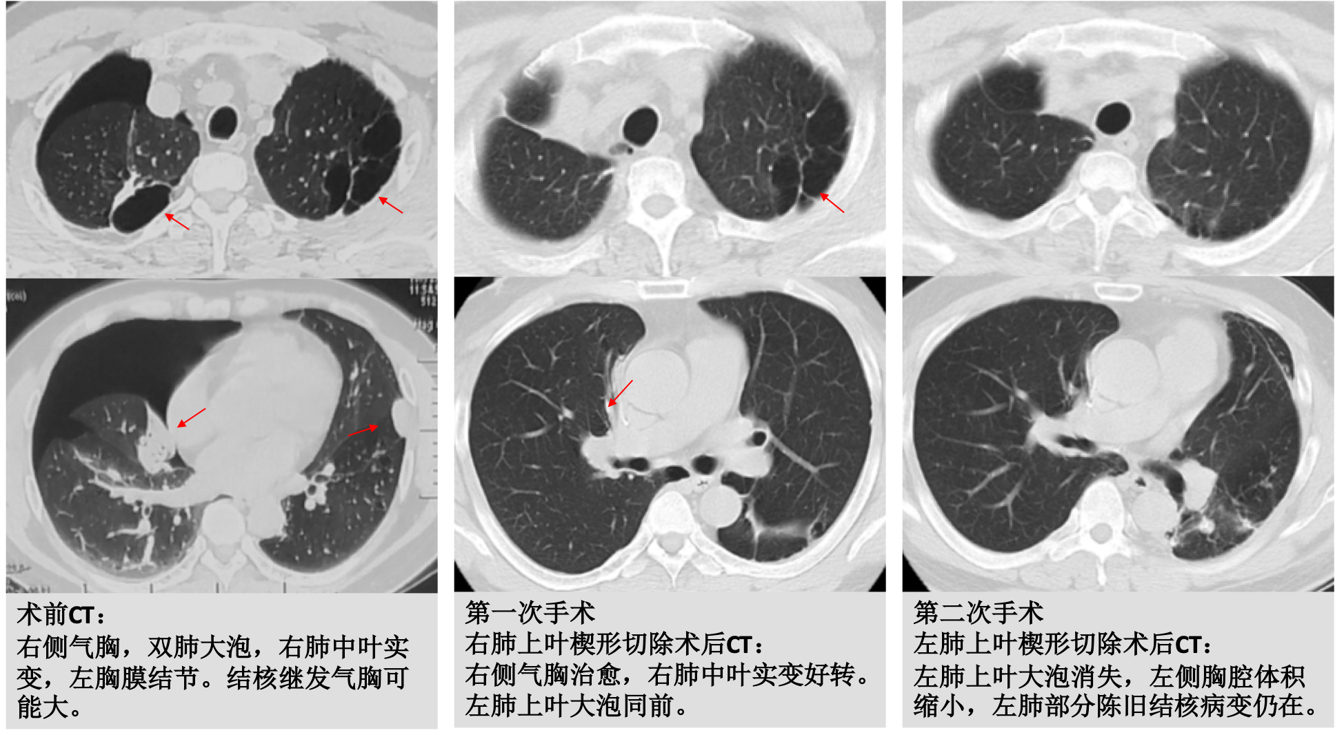 原创 | 气胸的形成和治疗_气胸_发病原因_治疗方式 - 好大夫在线