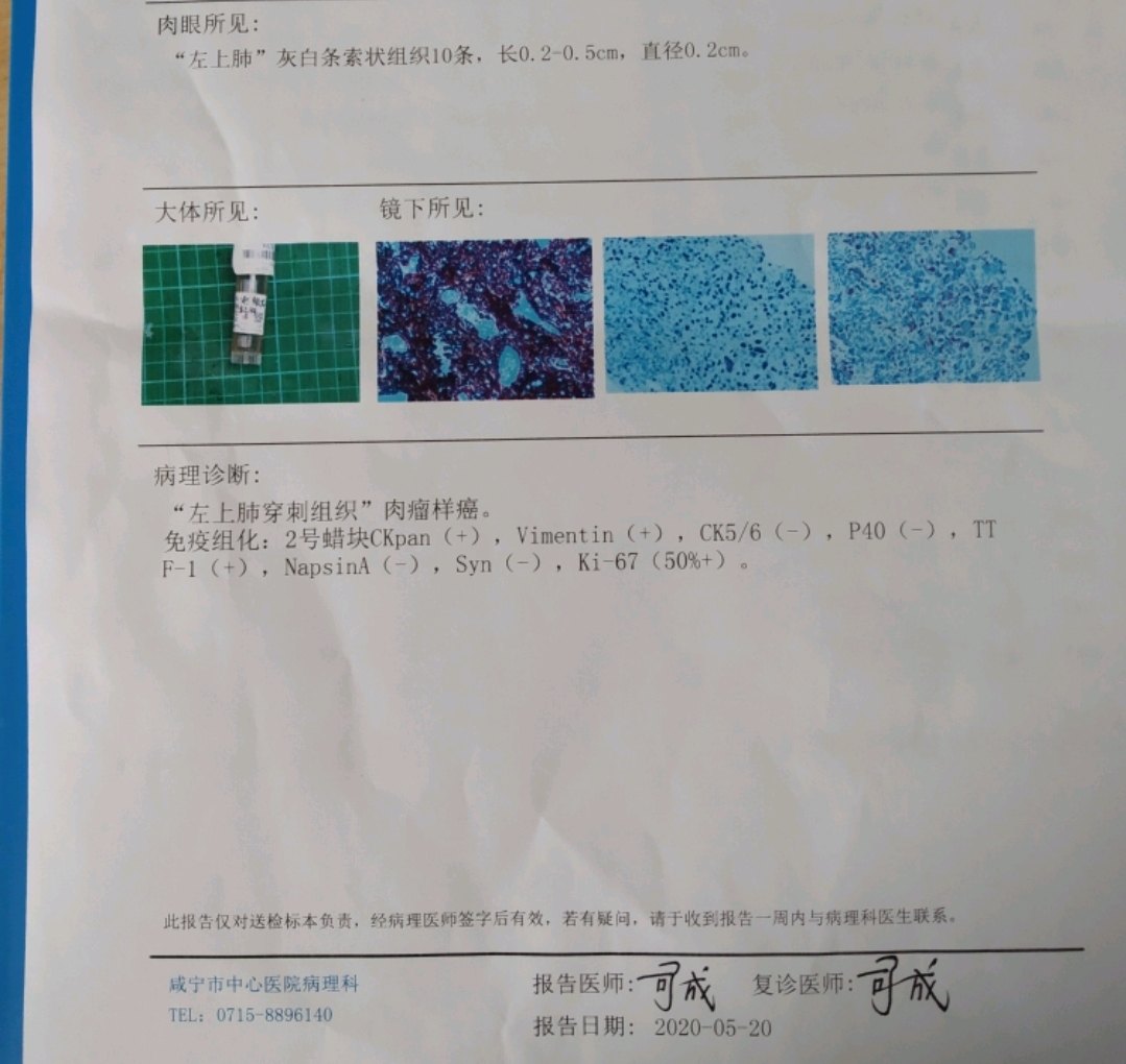刘懿博士说肺癌 一一七五 肺结节长成晚期肺癌前有很多机会可挽救 肺部结节 刘懿博士说肺癌 一一七五 肺结节长成晚期肺癌前有很多机会可挽救 肺部结节