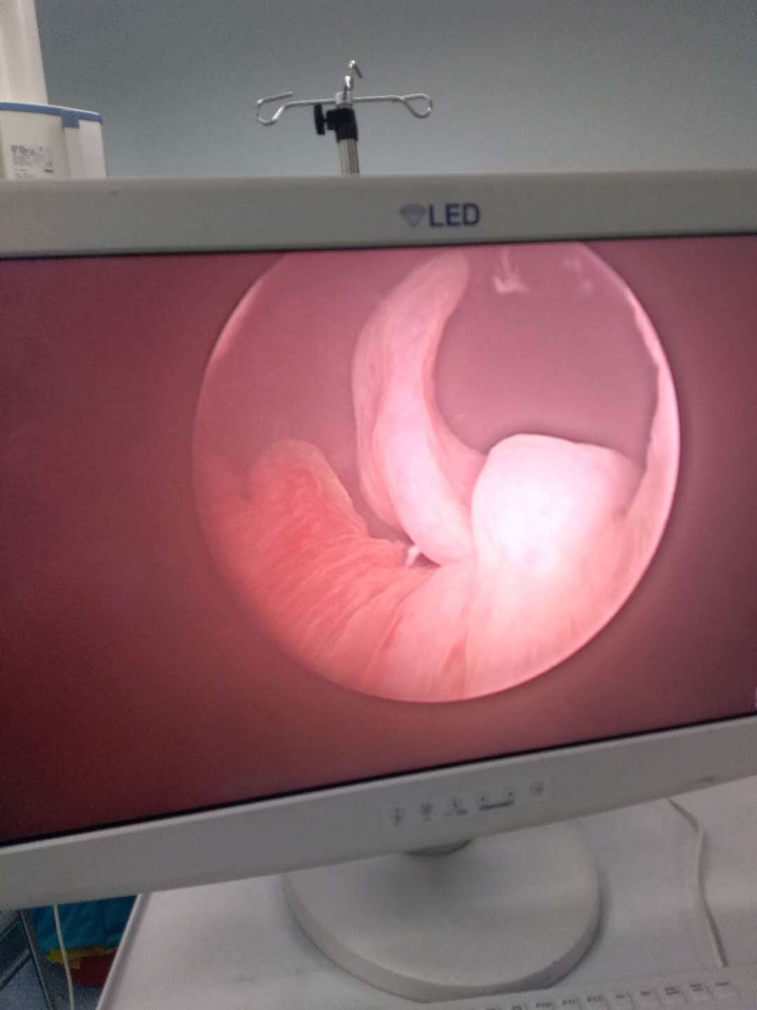 尿道息肉所致排尿困难一例 - 好大夫在线