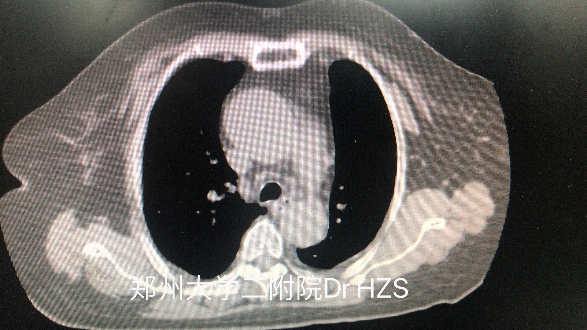 胸腺法新 肿瘤图片