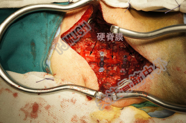 今日手术颈椎后路双开门椎管扩大成型术
