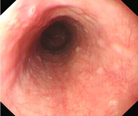 食管白斑图片胃镜图图片