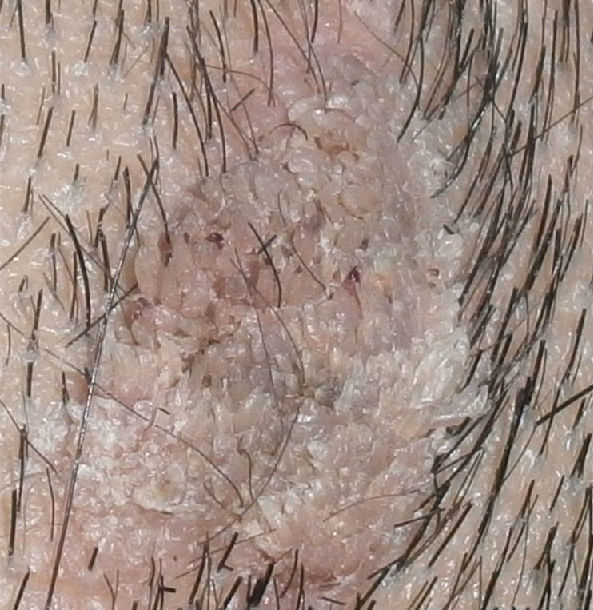 头皮下纤维瘤图片