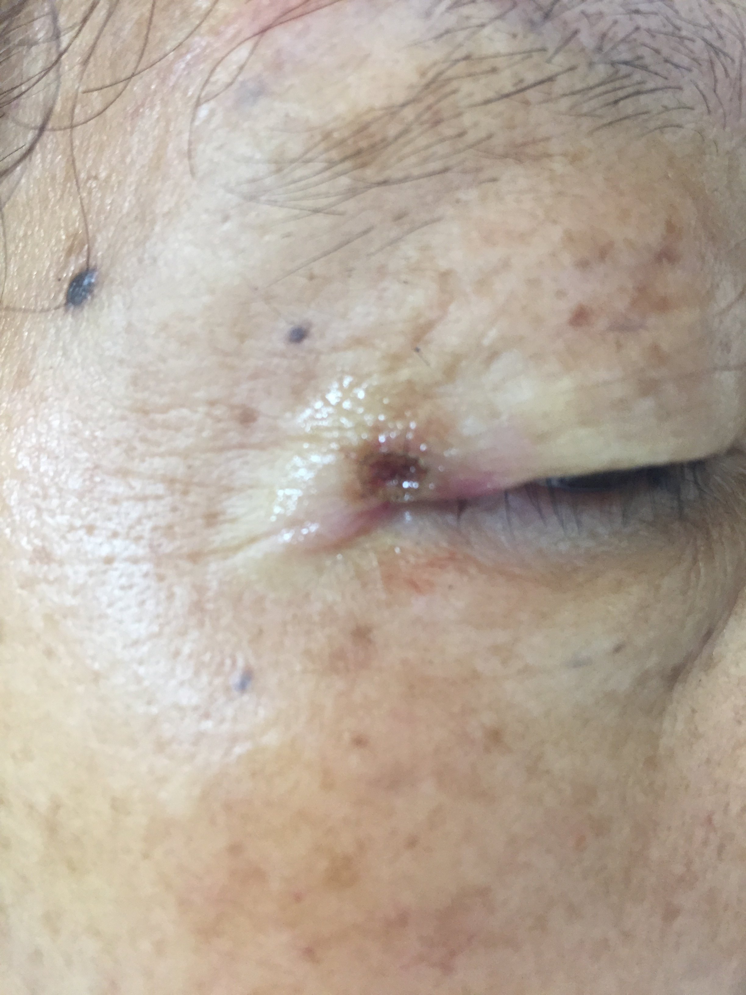 面部先天性黑色素痣手术过程