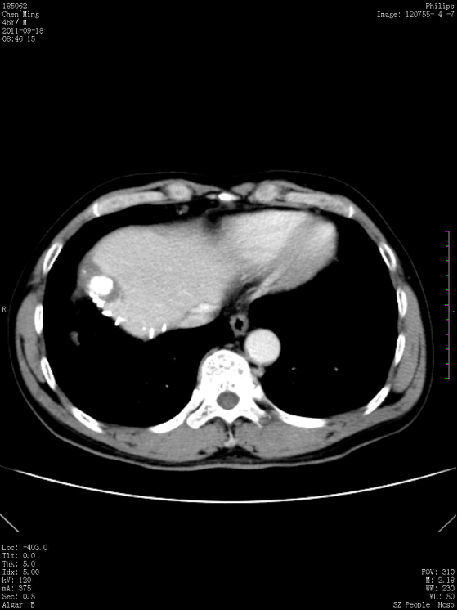 一例巨大肝癌消融治疗分享:兼答消融究竟能治疗多大的肝癌?
