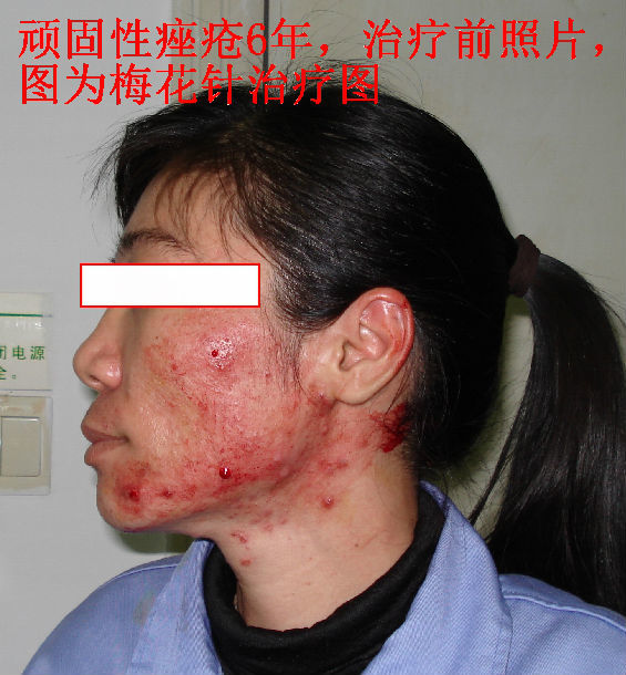 内分泌失调与顽固性痤疮(图)--答患者问_痤疮_痤疮疾病介绍 - 好大夫
