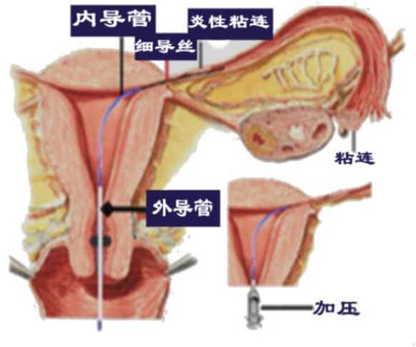 灌注疏通.jpg