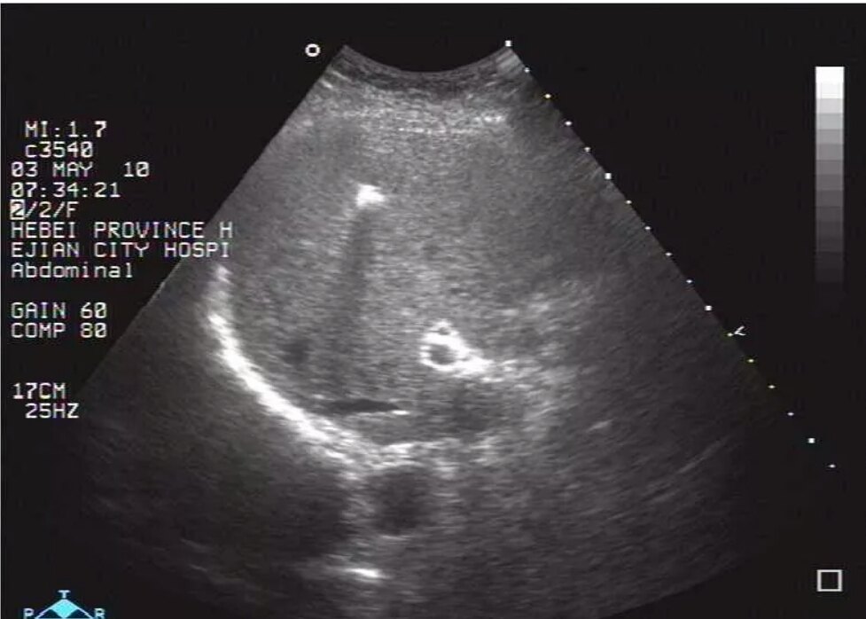 肝钙化灶的彩超图图片
