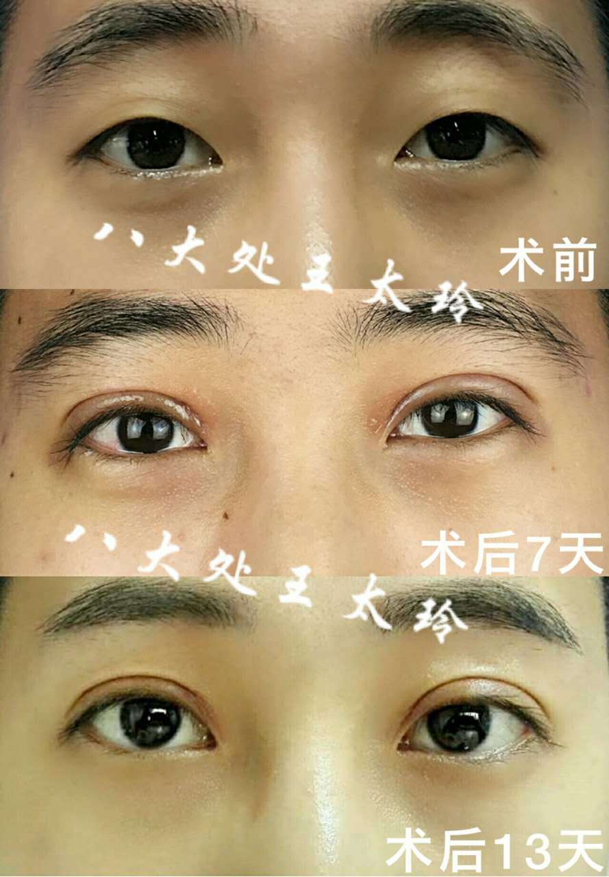 王太玲医生双眼皮案例分享11-20 - 好大夫在线